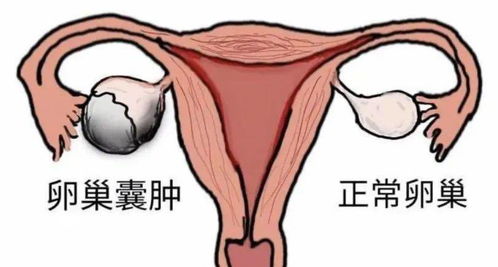 卵巢囊肿长多大需要手术