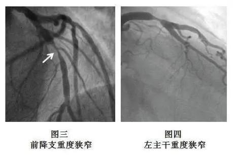 支架术后一年内坚持服药仍复发,只因这件 小事