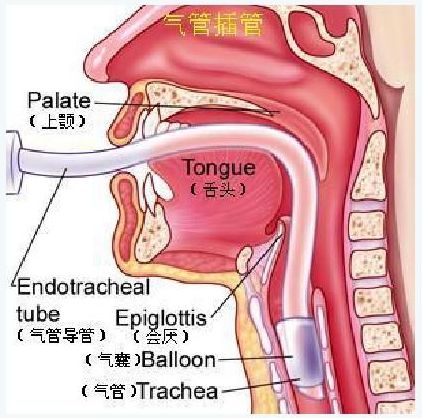 手术后病人咽干喉咙痛是麻醉造成的吗