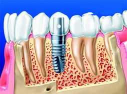拔牙后多久可以做种植牙修复
