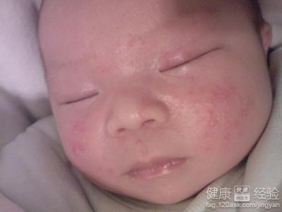 宝宝脸上湿疹怎么办？宝宝脸上长湿疹怎么办