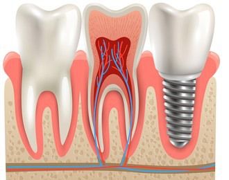 维乐 中泽口腔 种牙是种在哪里 做种植牙疼不疼