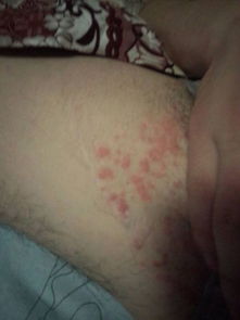 长在大腿内侧的红斑,这是什么病 有什么药可以治,如图 