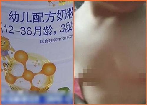 江西事件 疑饮用假奶粉后,1岁女婴胸部发育