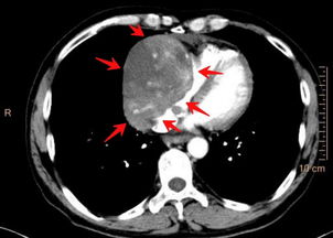 做完CT,医生又让做增强CT,什么是增强CT 很贵吧 