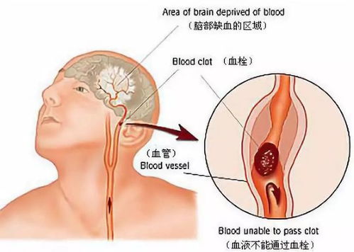 脑梗后还能彻底恢复吗 脑梗后遗症有方法治好吗