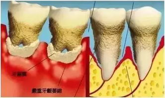 牙周炎症状(牙周炎症状是什么啊)