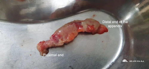 看图学病丨阑尾炎 Appendicitis