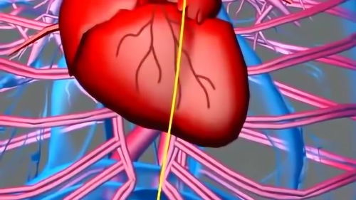 心脏支架是如何放进人体的 听听专家的解释,以前不明白的瞬间都明白了 