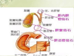 钬激光胆道碎石的护理