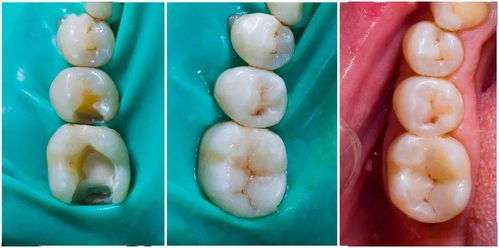 浅龋 中龋补牙就可以了,深龋牙髓炎要怎么办