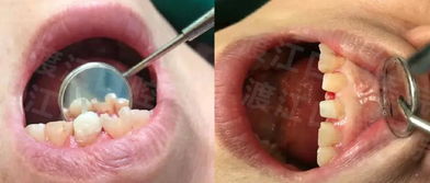 渡江口腔优秀病例展示 门牙缺损修复