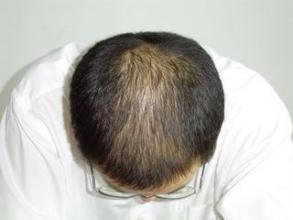 脂溢性脱发有解决办法吗 脱发几级可以植发