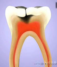 转载 乳牙牙髓炎发病过程图