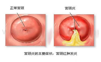 宫颈粘膜炎的病理