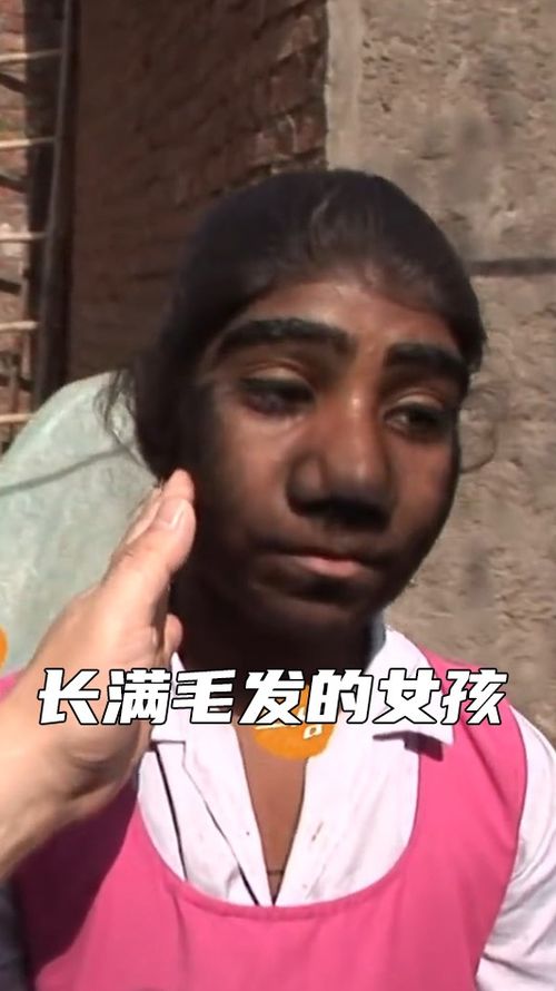 长满毛发的女孩 别人嘲笑她是个猴子 纪录片 