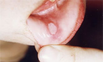 口腔溃疡是风湿并发症吗,口腔溃疡和风湿病的关系