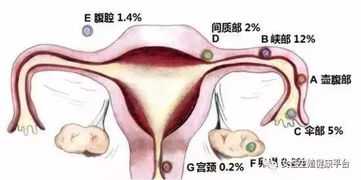 宫外孕威胁女性健康(宫外孕对女性的打击)