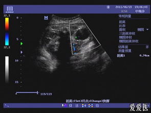 胎儿肾积水怎么办(超声检出胎儿肾积水该怎么办)