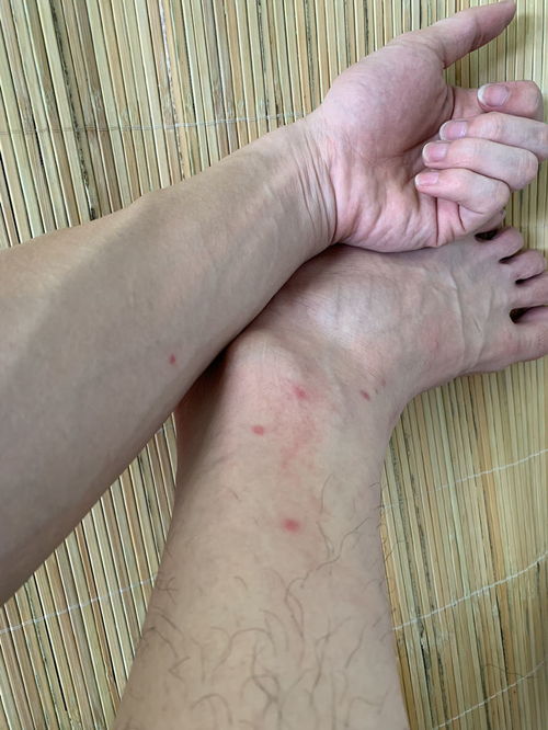 腿上长好多像这种红包越抓越痒手上也有是什么情况 好像不是蚊子咬的 