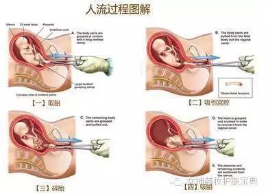 怀孕多少天可以人流(怀孕多少天可以人流掉)