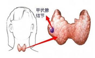 查出甲状腺结节怎么办 美国自然源为您解惑