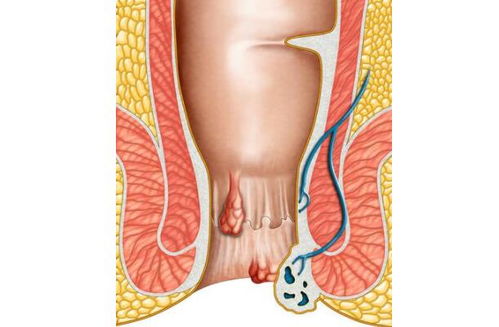 夏季肛门周围很痒,是天热闹的 医生 当心5种疾病缠上身