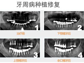 什么是种植牙修复 种植牙有哪些好处