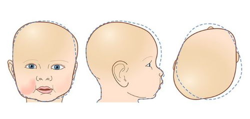 宝宝大小脸是怎么回事 还能正回来吗
