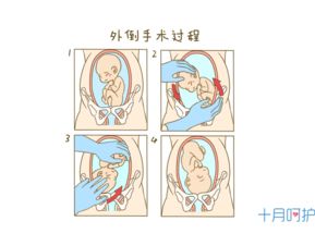 为什么现在有的医院不主张胎位纠正了为什么(为什么有些医院不给保胎)