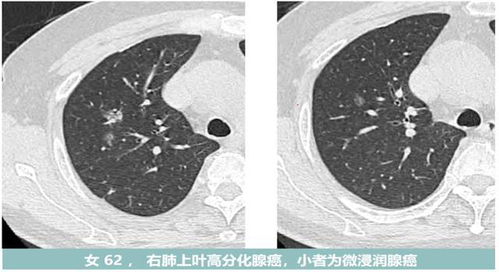 单发和多发肺结节哪个更可能是癌 如果多个肺结节都是癌可怕吗