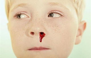鼻出血，鼻子流血是什么原因