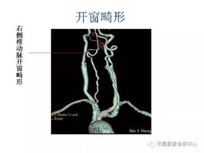 头颈部CTA及头颈部血管常见变异 