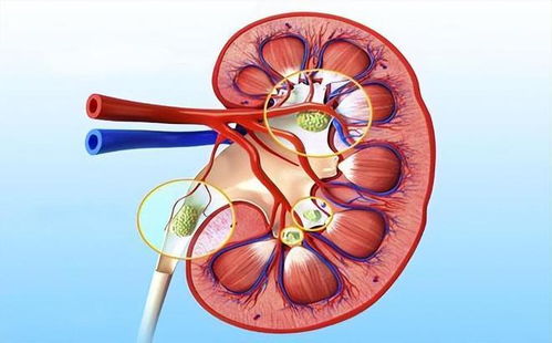 肾结石是 吃出来 的 医生建议 不想结石长大,多吃3样少吃5类