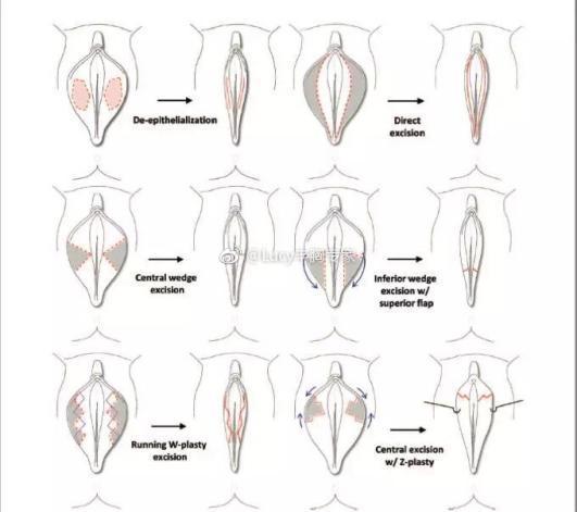 告别小阴唇肥大,重获少女般紧致私密 整形医生周明书