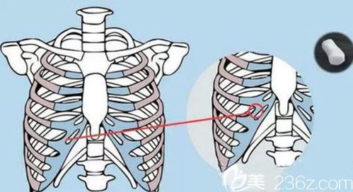 我惨痛的异体骨隆鼻后悔经历 做鼻子花了四万多不到9个月就感染了还闻到臭味