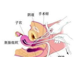 女人最多能承受几次人流 医生表示超过这个数字就别想要宝宝了