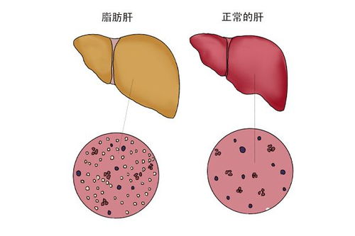 脂肪肝不用吃药,控制饮食就行 32岁男子的经历,该吸取教训