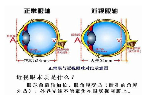 近视可以逆转吗 这样做,让孩子远离近视