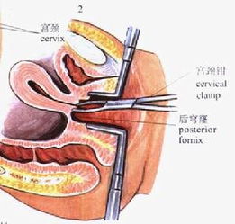 盆腔脓肿 