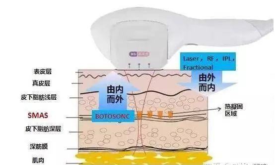 水光针和光子嫩肤能一起做吗