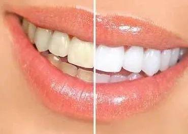 牙齿美白对牙齿有伤害吗