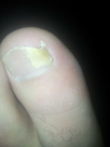 我的脚趾头指甲盖一半黄,怎么回事 