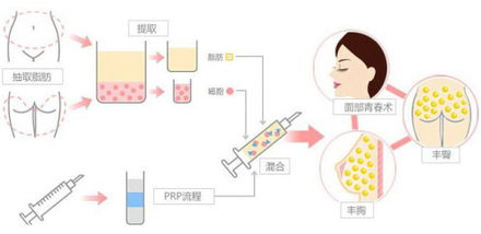 自体脂肪注射隆眉弓好不？