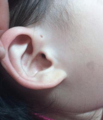 为何有的新生儿耳朵有 小孔 真是寓意着有福气 其实恰恰相反
