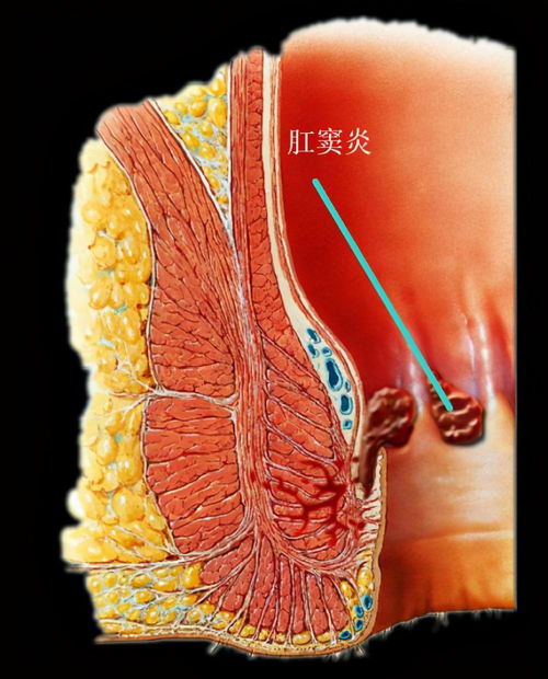 肛窦炎，两个肛窦发炎。不知道能不能治好(肛窦炎至肛门反复疼痛)