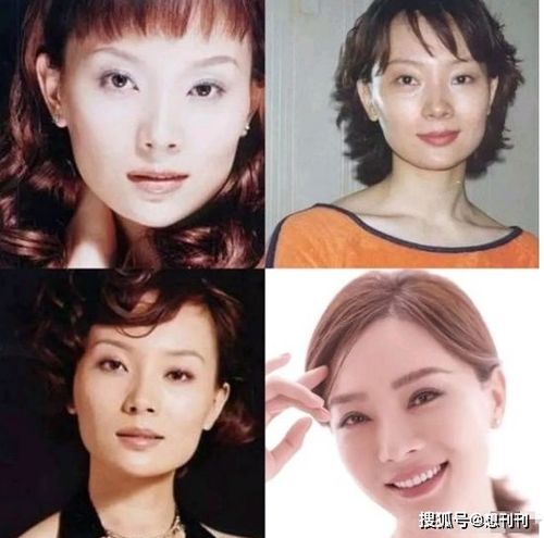 做了颧骨内推的明星真的变美了吗 推平容易后悔难,后遗症一大堆