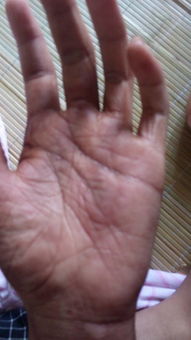 左手手掌金星丘疼,手相能看出哪些疾病
