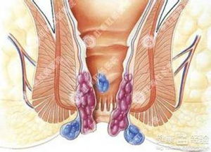 外痔疮的最佳治疗方法