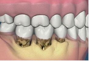 牙龈萎缩用中药效果如何 